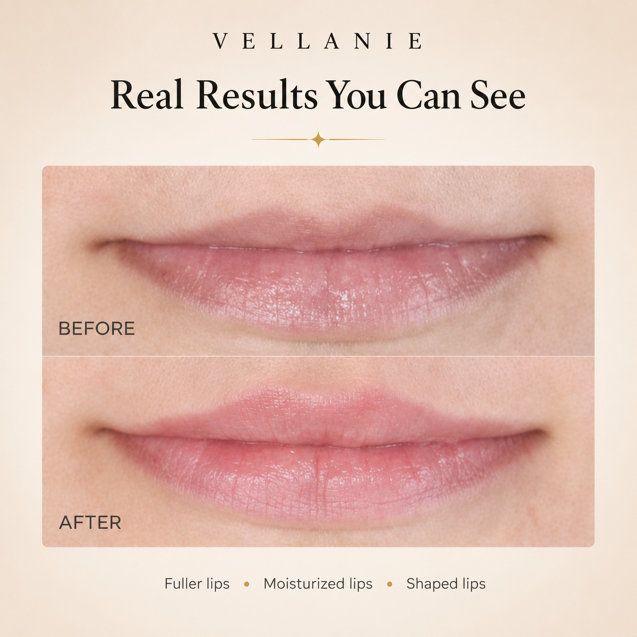 Vellanie™ LED Lip Plumper